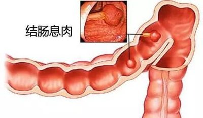 肠息肉术后一个月仍拉稀，原因、处理与预防