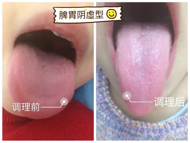 关于两个月宝宝舌苔厚白的原因分析及应对建议